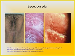 Leucorreia




http://depts.washington.edu/nnptc/online_training/std_handbook/gallery/pages/trichomonasdischg.html
http://www.saude.df.gov.br/003/00318005.asp?ttCD_CHAVE=22627
http://www.jornallivre.com.br/206318/o-que-causa-tricomoniase.html
 