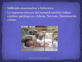 Infiltrado mononuclear y linfocitico. La respuesta inmune del huésped también induce cambios patológicos.= Edema, Necrosis, Descamación celular. Departamento de Agentes Biológicos 