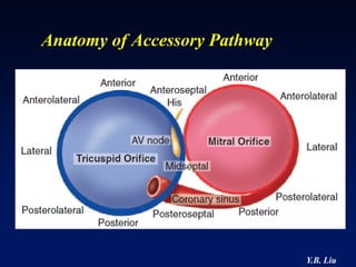 Anatomy of Accessory Pathway




                               Y.B. Liu
 