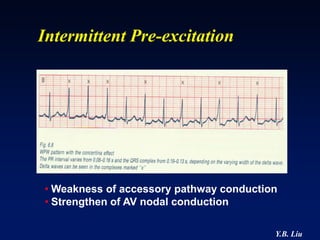 Intermittent Pre-excitation




• Weakness of accessory pathway conduction
• Strengthen of AV nodal conduction

                                         Y.B. Liu
 