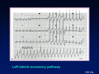 Left lateral accessory pathway
                                 Y.B. Liu
 