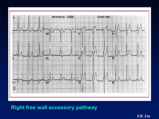 Right free wall accessory pathway
                                    Y.B. Liu
 
