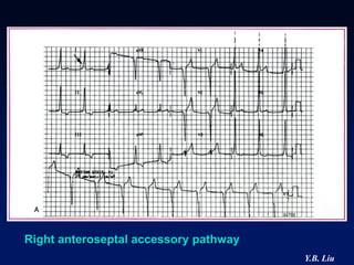 Right anteroseptal accessory pathway
                                       Y.B. Liu
 
