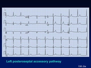 Left posteroseptal accessory pathway
                                       Y.B. Liu
 