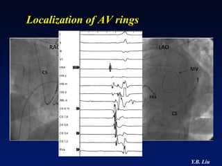 Localization of AV rings




                           Y.B. Liu
 