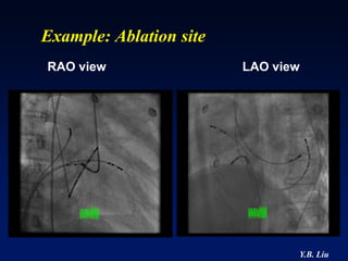 Example: Ablation site
RAO view                 LAO view




                                Y.B. Liu
 