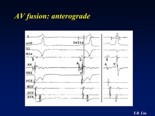 AV fusion: anterograde




                         Y.B. Liu
 
