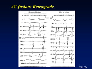 AV fusion: Retrograde




                        Y.B. Liu
 