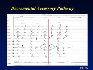 Decremental Accessory Pathway




                                Y.B. Liu
 