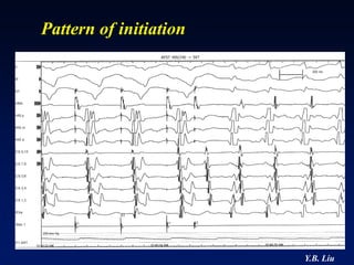 Pattern of initiation




                        Y.B. Liu
 