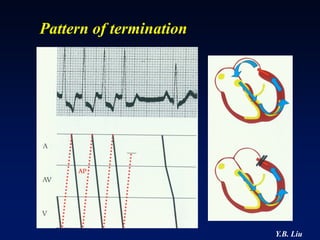Pattern of termination




                         Y.B. Liu
 