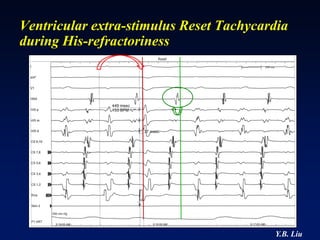 Ventricular extra-stimulus Reset Tachycardia
during His-refractoriness




                                         Y.B. Liu
 