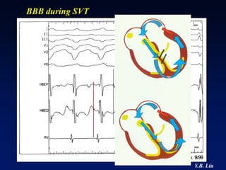 BBB during SVT




                 Y.B. Liu
 
