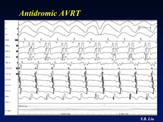 Antidromic AVRT




                  Y.B. Liu
 