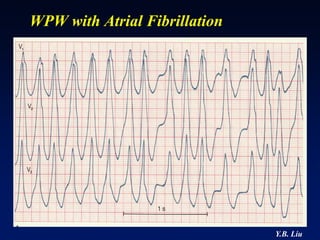 WPW with Atrial Fibrillation




                               Y.B. Liu
 