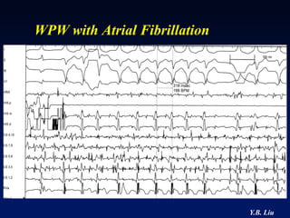 WPW with Atrial Fibrillation




                               Y.B. Liu
 