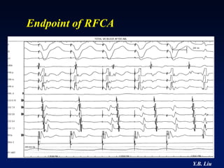 Endpoint of RFCA




                   Y.B. Liu
 
