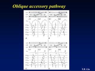 Oblique accessory pathway




                            Y.B. Liu
 