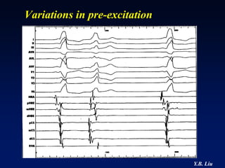 Variations in pre-excitation




                               Y.B. Liu
 