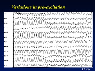 Variations in pre-excitation




                               Y.B. Liu
 