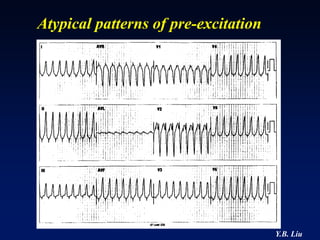 Atypical patterns of pre-excitation




                                      Y.B. Liu
 