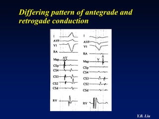 Differing pattern of antegrade and
retrogade conduction




                                     Y.B. Liu
 