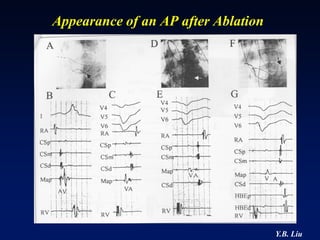 Appearance of an AP after Ablation




                                     Y.B. Liu
 
