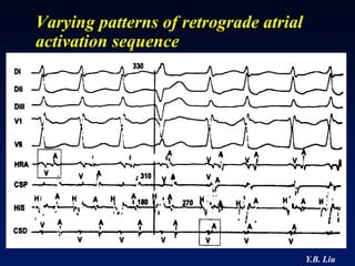 Varying patterns of retrograde atrial
activation sequence




                                        Y.B. Liu
 