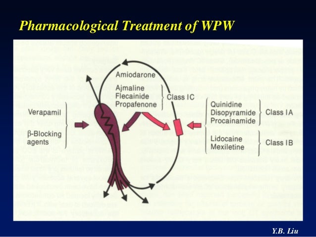 Wolff - Parkinson - White Syndrome Wolff - Parkinson - White Syndrome