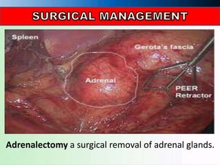 Adrenalectomy a surgical removal of adrenal glands.
 
