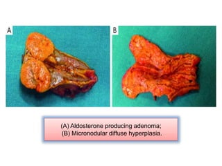(A) Aldosterone producing adenoma;
(B) Micronodular diffuse hyperplasia.
 