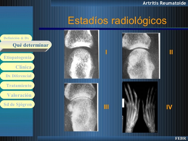 50. artritis reumatoide 50. artritis reumatoide