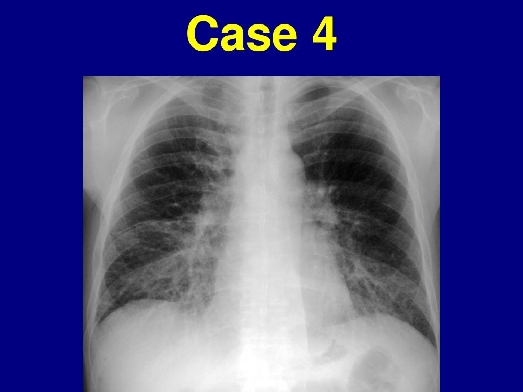 Radiographic Evaluation of Interstitial Lung Disease Laura E. Heynema…