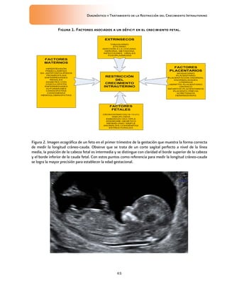 Diagnóstico y Tratamiento de la Restricción del Crecimiento Intrauterino
45
Figura 1. Factores asociados a un déficit en el crecimiento fetal.
Figura 1. Factores asociados a un déficit en el crecimiento fetal.
Figura 1. Factores asociados a un déficit en el crecimiento fetal.
Figura 1. Factores asociados a un déficit en el crecimiento fetal.
Figura 2. Imagen ecográfica de un feto en el primer trimestre de la gestación que muestra la forma correcta
de medir la longitud cráneo-cauda. Observe que se trata de un corte sagital perfecto a nivel de la línea
media, la posición de la cabeza fetal es intermedia y se distingue con claridad el borde superior de la cabeza
y el borde inferior de la cauda fetal. Con estos puntos como referencia para medir la longitud cráneo-cauda
se logra la mayor precisión para establecer la edad gestacional.
 