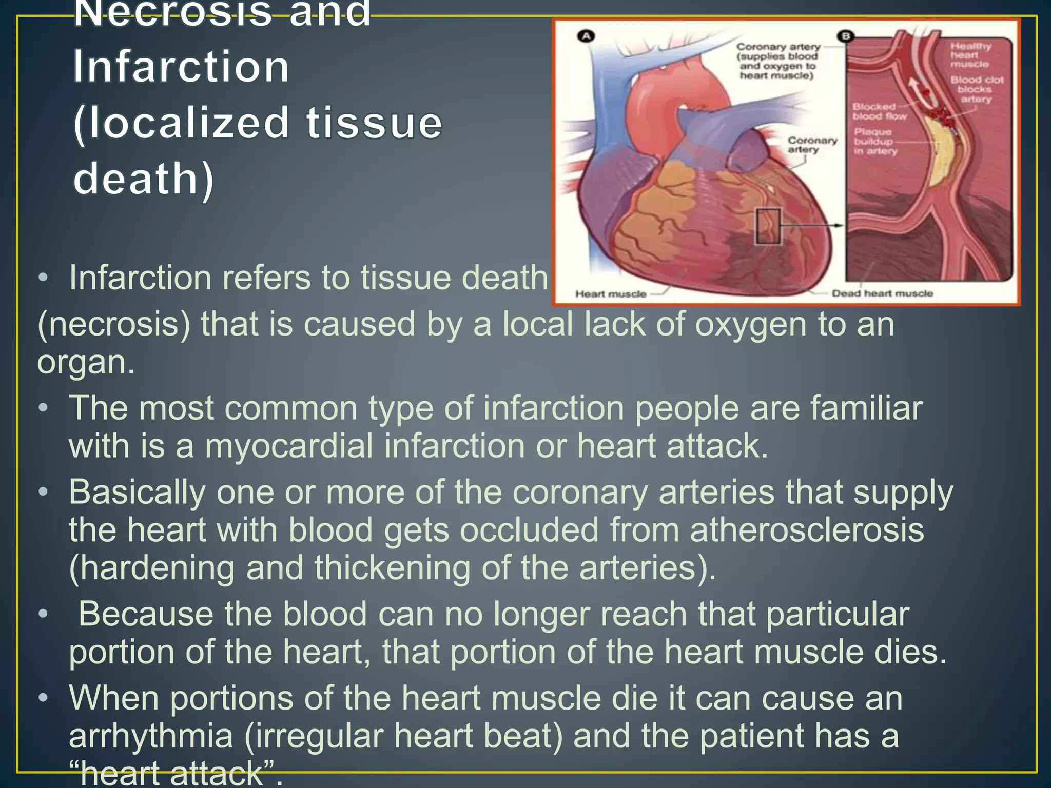 • Infarction refers to tissue death
(necrosis) that is caused by a local lack of oxygen to an
organ.
• The most common type of infarction people are familiar
with is a myocardial infarction or heart attack.
• Basically one or more of the coronary arteries that supply
the heart with blood gets occluded from atherosclerosis
(hardening and thickening of the arteries).
• Because the blood can no longer reach that particular
portion of the heart, that portion of the heart muscle dies.
• When portions of the heart muscle die it can cause an
arrhythmia (irregular heart beat) and the patient has a
“heart attack”.
 