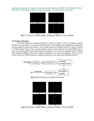 International Journal of Computer Engineering and Technology (IJCET), ISSN 0976-6367(Print),
ISSN 0976 - 6375(Online), Volume 4, Issue 6, November - December (2013), © IAEME

Fig. 3. (a) Normal, (b)Mild NPDR, (c) Moderate NPDR, (d) Severe NPDR
3.3 Exudates Detection
The block diagram for exudates detection is shown in figure 5. First, to facilitate exudates
detection, the optic disc is located and eliminated [23]. Thresholding and morphological operations
are then applied to detect the exudates. Few example images of exudates detection is shown in figure
6. Normal retinal image do not contain exudates (fig.6.a), retina affected with mild NPDR may or
may not contain exudates, but if present they are limited to few in only one quadrant (fig.6.b). Retina
with moderate NPDR contains few exudates distributed in at least two quadrants (fig.6.c) and in
retinal with severe NPDR numerous exudates are present in more than three quadrants (fig.6.d).

Fig. 4. Block Diagram for Exudates Extraction

Fig: 6.(a) Normal, (b)Mild NPDR, (c) Moderate NPDR, (d) Severe NPDR
5

 