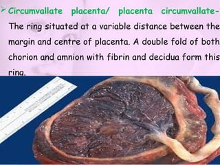 Chorionic Ring 501340725-Unit-2-Fertilization-impantation-development-of-placenta-and ...
