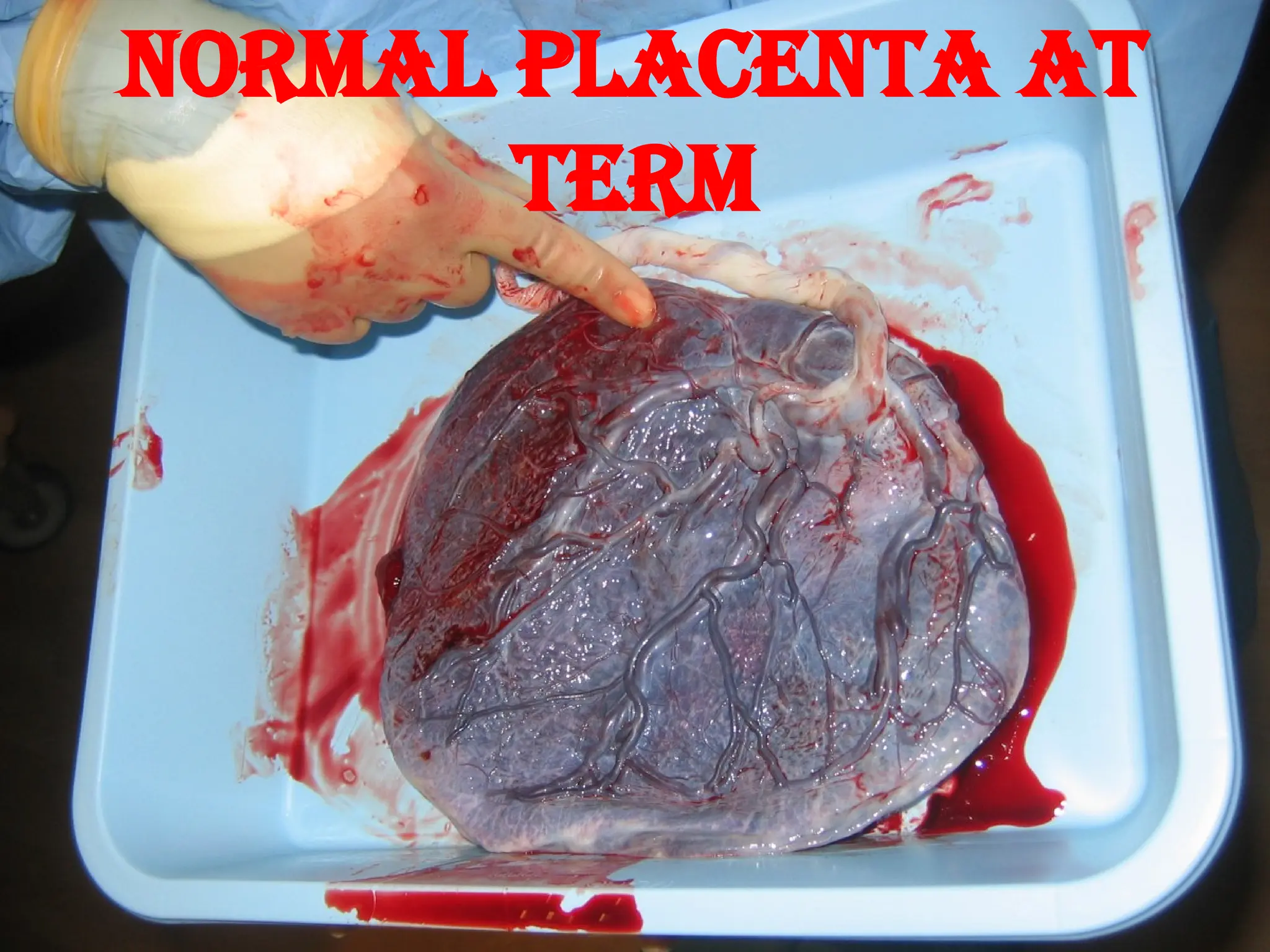 Normal placenta at
term
 