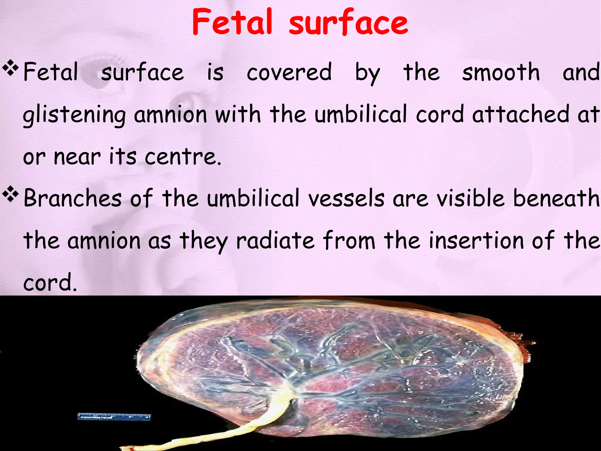 Fetal surface
Fetal surface is covered by the smooth and
glistening amnion with the umbilical cord attached at
or near its centre.
Branches of the umbilical vessels are visible beneath
the amnion as they radiate from the insertion of the
cord.
 