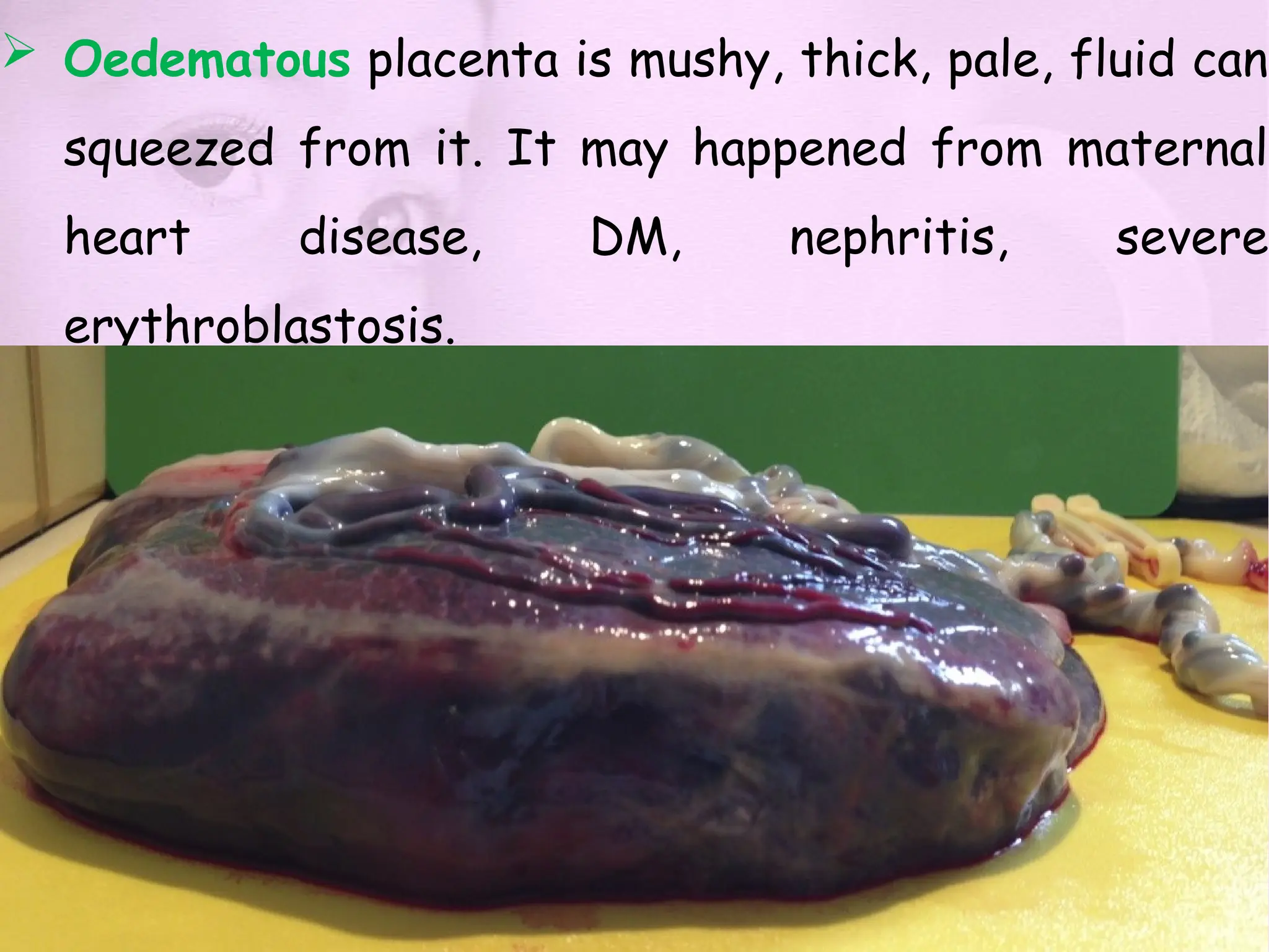  Oedematous placenta is mushy, thick, pale, fluid can
squeezed from it. It may happened from maternal
heart disease, DM, nephritis, severe
erythroblastosis.
 