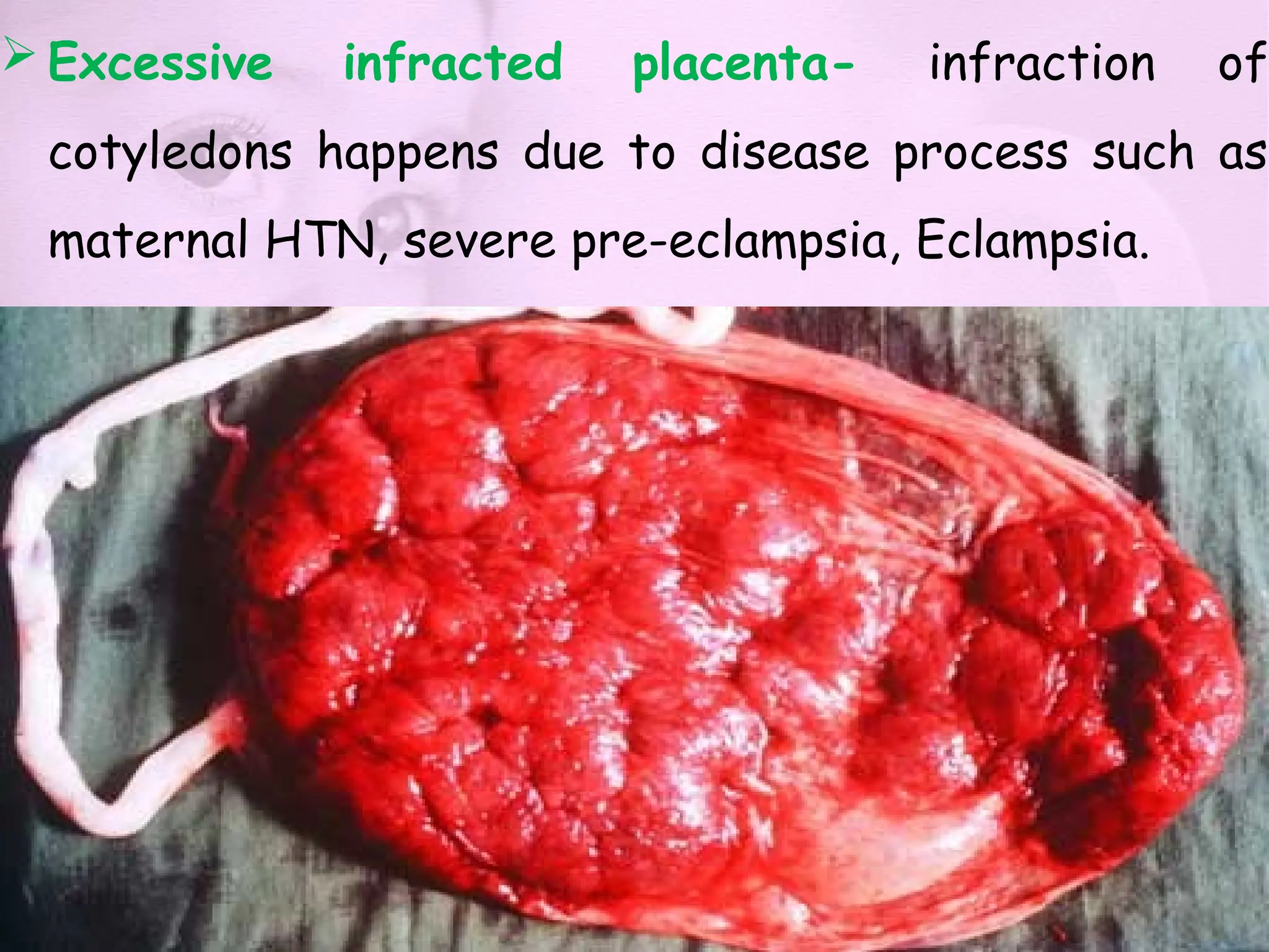  Excessive infracted placenta- infraction of
cotyledons happens due to disease process such as
maternal HTN, severe pre-eclampsia, Eclampsia.
 