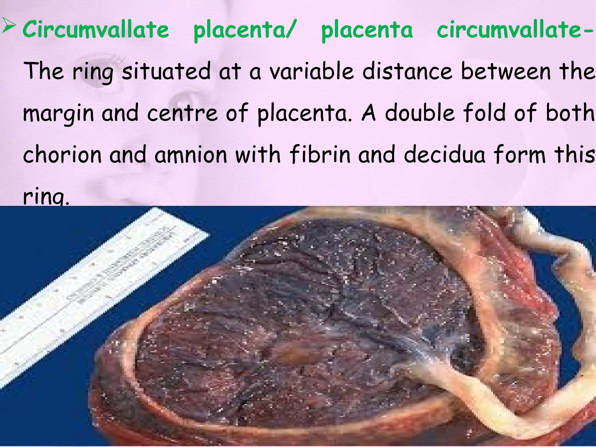  Circumvallate placenta/ placenta circumvallate-
The ring situated at a variable distance between the
margin and centre of placenta. A double fold of both
chorion and amnion with fibrin and decidua form this
ring.
 