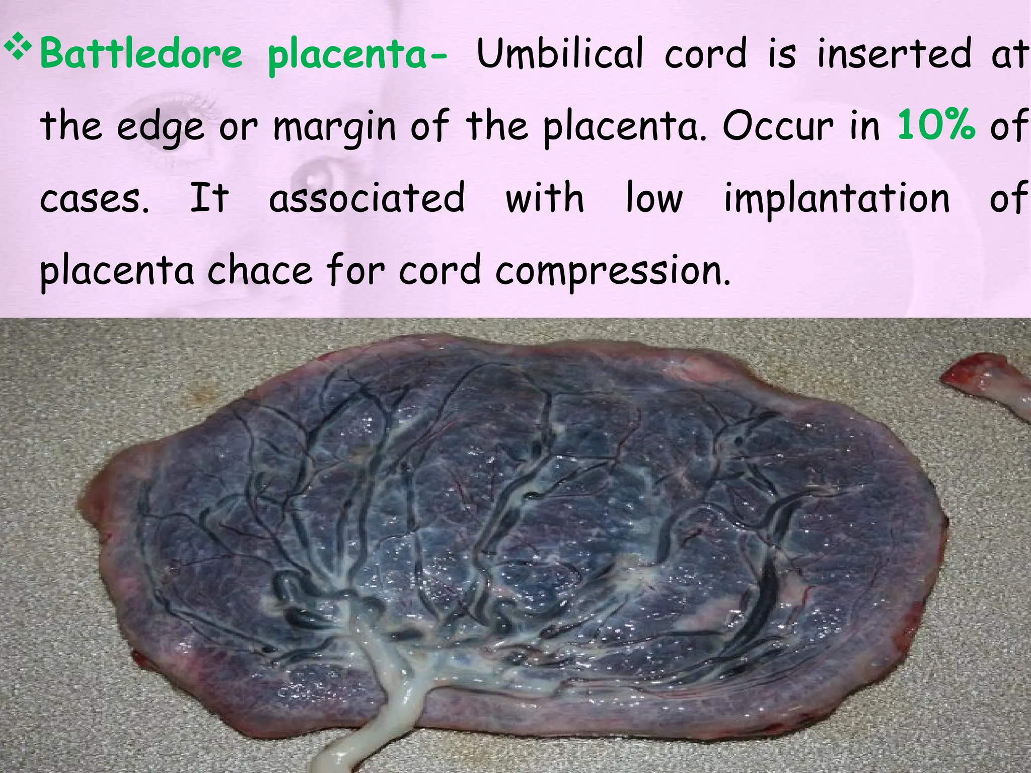 Battledore placenta- Umbilical cord is inserted at
the edge or margin of the placenta. Occur in 10% of
cases. It associated with low implantation of
placenta chace for cord compression.
 
