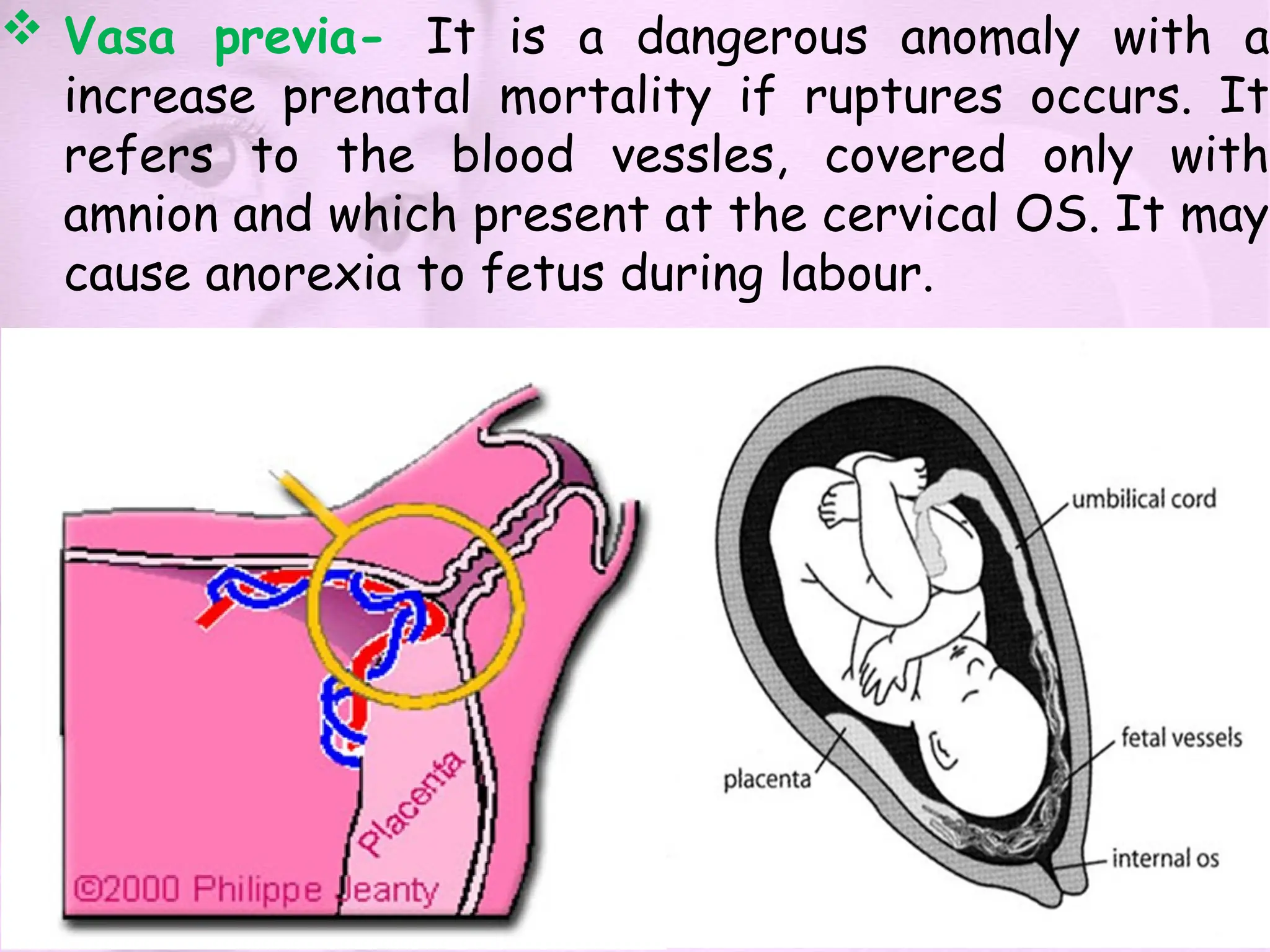  Vasa previa- It is a dangerous anomaly with a
increase prenatal mortality if ruptures occurs. It
refers to the blood vessles, covered only with
amnion and which present at the cervical OS. It may
cause anorexia to fetus during labour.
 