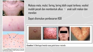 Comprehensive Overview of Varicella (Chickenpox): Etiology, Diagnosis ...