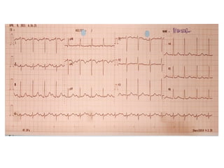 Detailed ECG Case Studies: AV Block and STEMI Anterior Analysis | PPTX