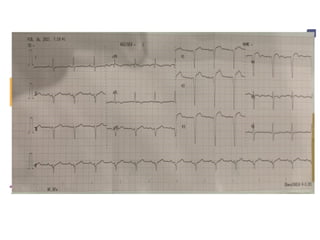 Detailed ECG Case Studies: AV Block and STEMI Anterior Analysis | PPTX