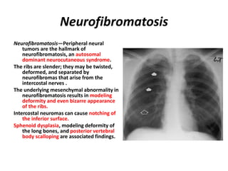 Neurofibromatosis
Neurofibromatosis—Peripheral neural
tumors are the hallmark of
neurofibromatosis, an autosomal
dominant neurocutaneous syndrome.
The ribs are slender; they may be twisted,
deformed, and separated by
neurofibromas that arise from the
intercostal nerves .
The underlying mesenchymal abnormality in
neurofibromatosis results in modeling
deformity and even bizarre appearance
of the ribs.
Intercostal neuromas can cause notching of
the inferior surface.
Sphenoid dysplasia, modeling deformity of
the long bones, and posterior vertebral
body scalloping are associated findings.
 