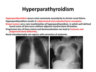 Hyperparathyroidism
Hyperparathyroidism occurs most commonly secondarily to chronic renal failure.
Hyperparathyroidism results in subperiosteal and endosteal bone resorption.
Brown tumors are a rare manifestation of hyperparathyroidism, in which well-defined
lucent areas of lysis occur without adjacent reactive bone formation.
Progressive loss of bone matrix and demineralization can lead to fractures and
progressive bone deformity .
Renal osteodystrophy can regress with correction of azotemia.
 