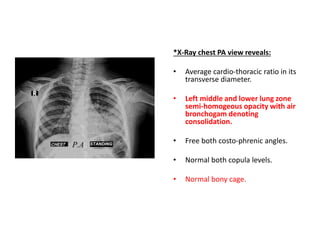*X-Ray chest PA view reveals:
• Average cardio-thoracic ratio in its
transverse diameter.
• Left middle and lower lung zone
semi-homogeous opacity with air
bronchogam denoting
consolidation.
• Free both costo-phrenic angles.
• Normal both copula levels.
• Normal bony cage.
 